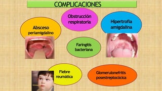COMPLICACIONES
Obstrucción
respiratoria
Absceso
periamigdalino
Hipertrofia
amigdalina
Faringitis
bacteriana
Fiebre
reumática
Glomerulonefritis
posestreptocócica
 