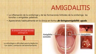 AMIGDALITIS
• La inflamación de la orofaringe y de las formaciones linfoides de la orofaringe, las
tonsilas o amígdalas palatinas.
• Apareciendo habitualmente en la clínica en forma de faringoamigdalitis aguda.
El síntoma principal de esta
patología es
La odinofagia o dificultad para la deglución
con dolor y sensación de estrechamiento.
 
