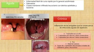 Aguda
Crónica
• Enfermedad febril de curso rápido por lo general autolímitada
• Edematosa
• Criptas mantienen infiltrado leucocitario con detritos epiteliales y
bacterias
Inflamación de las amígdalas que es consecuencia
de infecciones agudas de repetición.
 7 episodios en un año
 5 episodios por año en 2 años consecutivos
 3 episodios por año en 3 años consecutivos
 Pus
 Material caseoso
 Capas de c. epiteliales descamadas (cristales de
colesterol, grasa y leucocitos)
 