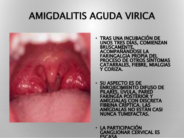 Amigdalitis aguda