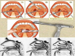 Amigdalitis crónica