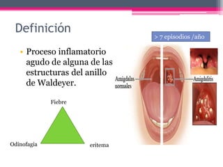 Definición
• Proceso inflamatorio
agudo de alguna de las
estructuras del anillo
de Waldeyer.
Fiebre
eritemaOdinofagia
> 7 episodios /año