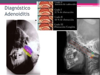 Diagnóstico
Adenoiditis
-Línea imaginaria
a lo largo del
paladar blando.
-Línea paralela a
la base de cráneo.
Radiografía de
cavum faríngeo