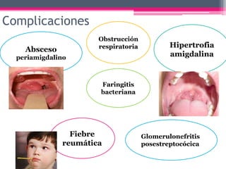 Obstrucción
respiratoriaAbsceso
periamigdalino
Complicaciones
Hipertrofia
amigdalina
Faringitis
bacteriana
Fiebre
reumática
Glomerulonefritis
posestreptocócica