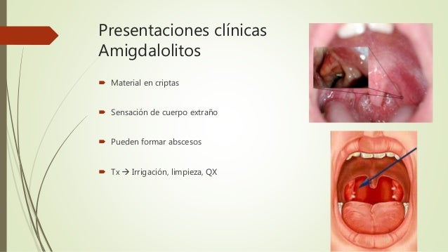 Adenoamigdalitis y complicaciones Adenoamigdalitis y complicaciones