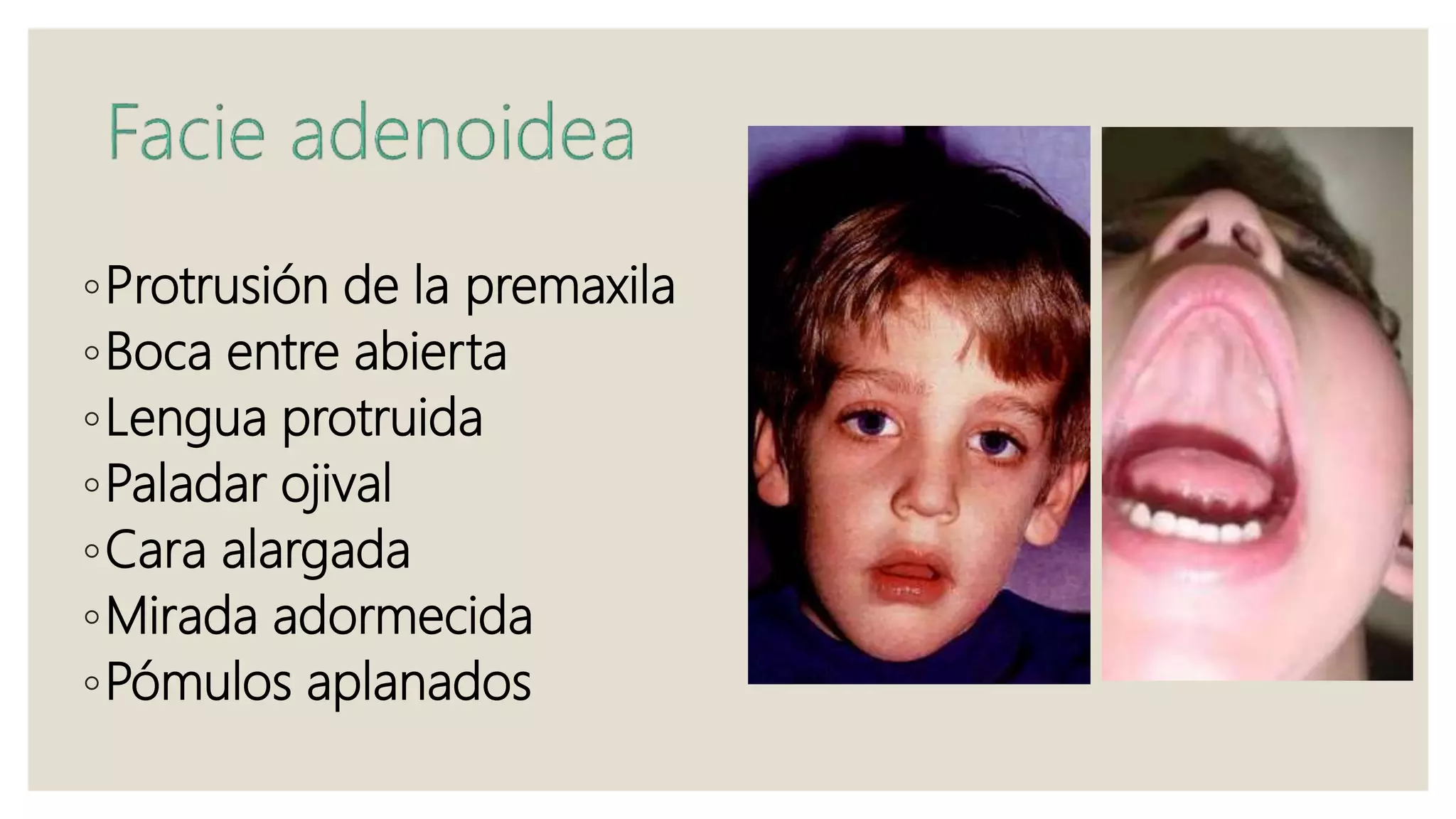 ◦Protrusión de la premaxila
◦Boca entre abierta
◦Lengua protruida
◦Paladar ojival
◦Cara alargada
◦Mirada adormecida
◦Pómulos aplanados
 