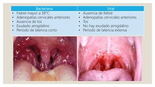 Bacteriana Viral
• Fiebre mayor a 38°C
• Adenopatías cervicales anteriores
• Ausencia de tos
• Exudado amigdalino
• Periodo de latencia corto
• Ausencia de fiebre
• Adenopatías cervicales anteriores
• Tos
• No hay exudado amigdalino
• Periodo de latencia extensa
 