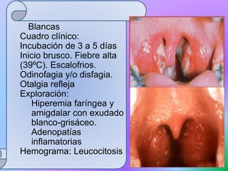Blancas
Cuadro clínico:
Incubación de 3 a 5 días
Inicio brusco. Fiebre alta
(39ºC). Escalofrios.
Odinofagia y/o disfagia.
Otalgia refleja
Exploración:
Hiperemia faríngea y
amigdalar con exudado
blanco-grisáceo.
Adenopatías
inflamatorias
Hemograma: Leucocitosis
 