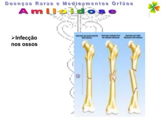 Infecção
nos ossos
 