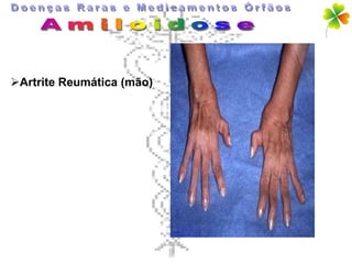 Artrite Reumática (mão)
 