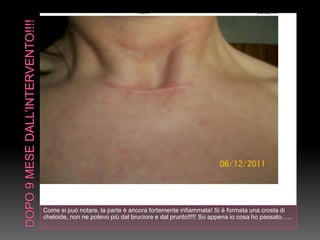 Come si può notare, la parte è ancora fortemente infiammata! Si è formata una crosta di
cheloide, non ne potevo più dal bruciore e dal prurito!!!!! So appena io cosa ho passato…..
 