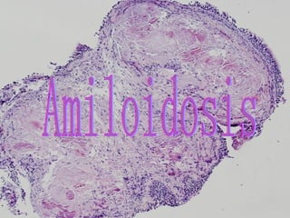 Amiloidosis 