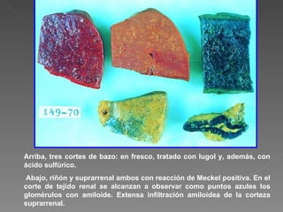 Arriba, tres cortes de bazo: en fresco, tratado con lugol y, además, con ácido sulfúrico. Abajo, riñón y suprarrenal ambos con reacción de Meckel positiva. En el corte de tejido renal se alcanzan a observar como puntos azules los glomérulos con amiloide. Extensa infiltración amiloídea de la corteza suprarrenal.  