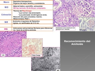 Reconocimiento del Amiloide 