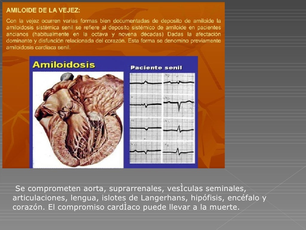 Amiloidosis Dr Loredo