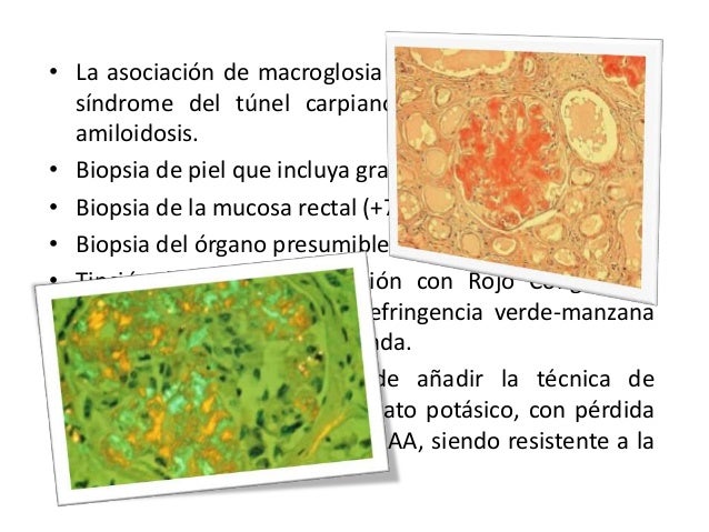 cadenas ligeras lambda altas amiloidosis renal cadenas ligeras lambda altas amiloidosis renal
