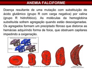 ANEMIA FALCIFORME
Doença resultante de uma mutação com substituição de
ácido glutâmico (grupo R com carga negativa) por valina
(grupo R hidrofóbico). As moléculas da hemoglobina
substituída sofrem agregação quando estão desoxigenadas.
Os agregados formam um preciptado fibroso que distorce as
hemácias adquirindo forma de foice, que obstruem capilares
impedindo a oxigenação.
 