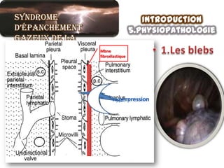 Syndrome                            Introduction
d’épanchement                    5.physiopathologie
gazeux de la
grande cavité   Mbne

pleurale        fibroélastique
 