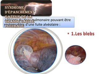 Syndrome
 d’épanchement
 gazeux de la
lésions du tissu pulmonaire pouvant être
 grande cavité
responsables d’une fuite alvéolaire :
 pleurale
 
