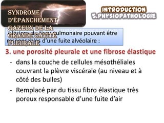 Syndrome                             Introduction
                                 5.physiopathologie
 d’épanchement
 gazeux de la
lésions du tissu pulmonaire pouvant être
 grande cavité
responsables d’une fuite alvéolaire :
 pleurale

 - dans la couche de cellules mésothéliales
   couvrant la plèvre viscérale (au niveau et à
   côté des bulles)
 - Remplacé par du tissu fibro élastique très
   poreux responsable d’une fuite d’air
 