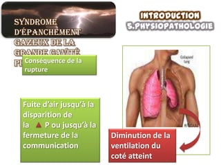 Introduction
Syndrome                      5.physiopathologie
d’épanchement
gazeux de la
grande cavité
pleurale de la
   Conséquence
  rupture



 Fuite d’air jusqu’à la
 disparition de
 la    P ou jusqu’à la
 fermeture de la          Diminution de la
 communication            ventilation du
                          coté atteint
 