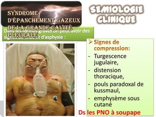Syndrome
d’épanchement gazeux
de la grande cavité
pleurale


                       - Turgescence
                         jugulaire,
                       - distension
                         thoracique,
                       - pouls paradoxal de
                         kussmaul,
                       - emphysème sous
                         cutané
                   Ds les PNO à soupape
 