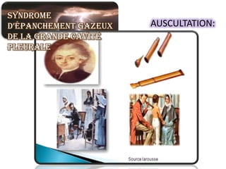 Syndrome
d’épanchement gazeux   AUSCULTATION:
de la grande cavité
pleurale
 