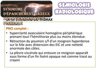 Syndrome
d’épanchement gazeux
de la grande cavité
 LA RX STANDARD DU THORAX
pleurale
 Résultats :

 • hyperclarté avasculaire homogène périphérique
   prenant tout l’hémithorax plus ou moins étendue.
 • Rétraction du poumon s/f d’un moignon hyperdense
   sur le hile avec distension des EIC et une netteté
   anormale des côtes.
 • La plèvre viscérale qui entoure ce moignon apparaît
   sous forme d’un fin liséré opaque net comme tracé au
   crayon
 