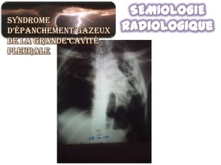 Syndrome
d’épanchement gazeux
de la grande cavité
pleurale
 