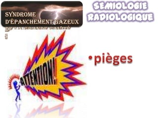 Syndrome
d’épanchement gazeux
de la grande cavité
pleurale
 