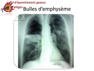 Bulles d’emphysème
 
