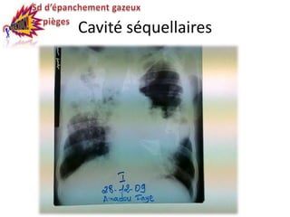Cavité séquellaires
 