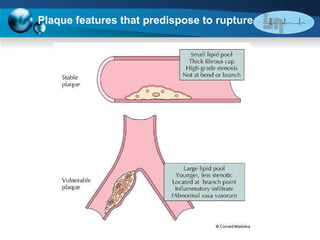 Plaque features that predispose to rupture 
