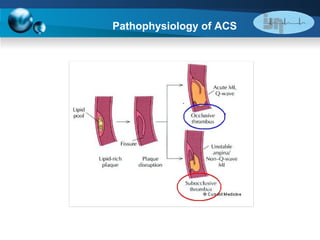 Pathophysiology of ACS 