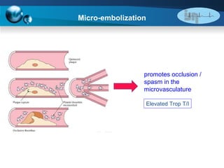 Micro-embolization promotes occlusion / spasm in the microvasculature Elevated Trop T/I 