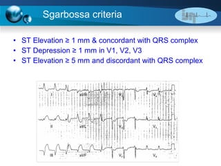 Sgarbossa criteria ST Elevation ≥ 1 mm & concordant with QRS complex ST Depression ≥ 1 mm in V1, V2, V3 ST Elevation ≥ 5 mm and discordant with QRS complex 