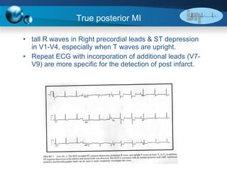True posterior MI tall R waves in Right precordial leads & ST depression in V1-V4, especially when T waves are upright. Repeat ECG with incorporation of additional leads (V7-V9) are more specific for the detection of post infarct. 