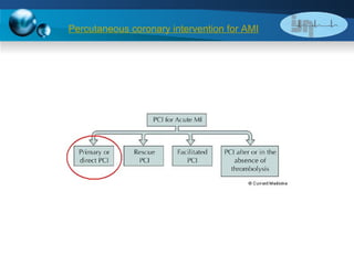 Percutaneous coronary intervention for AMI 