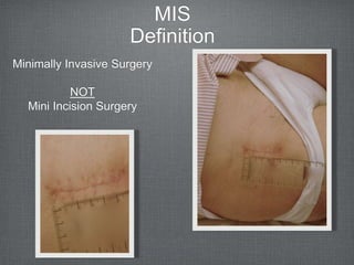 Mis Incision Amis - tips and tricks | PPTX