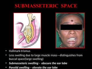 space infection in oral [Autosaved].pptx