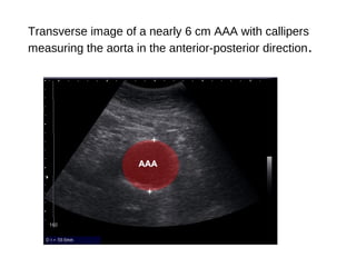 Abdominal Aortic Aneurysms | PPT