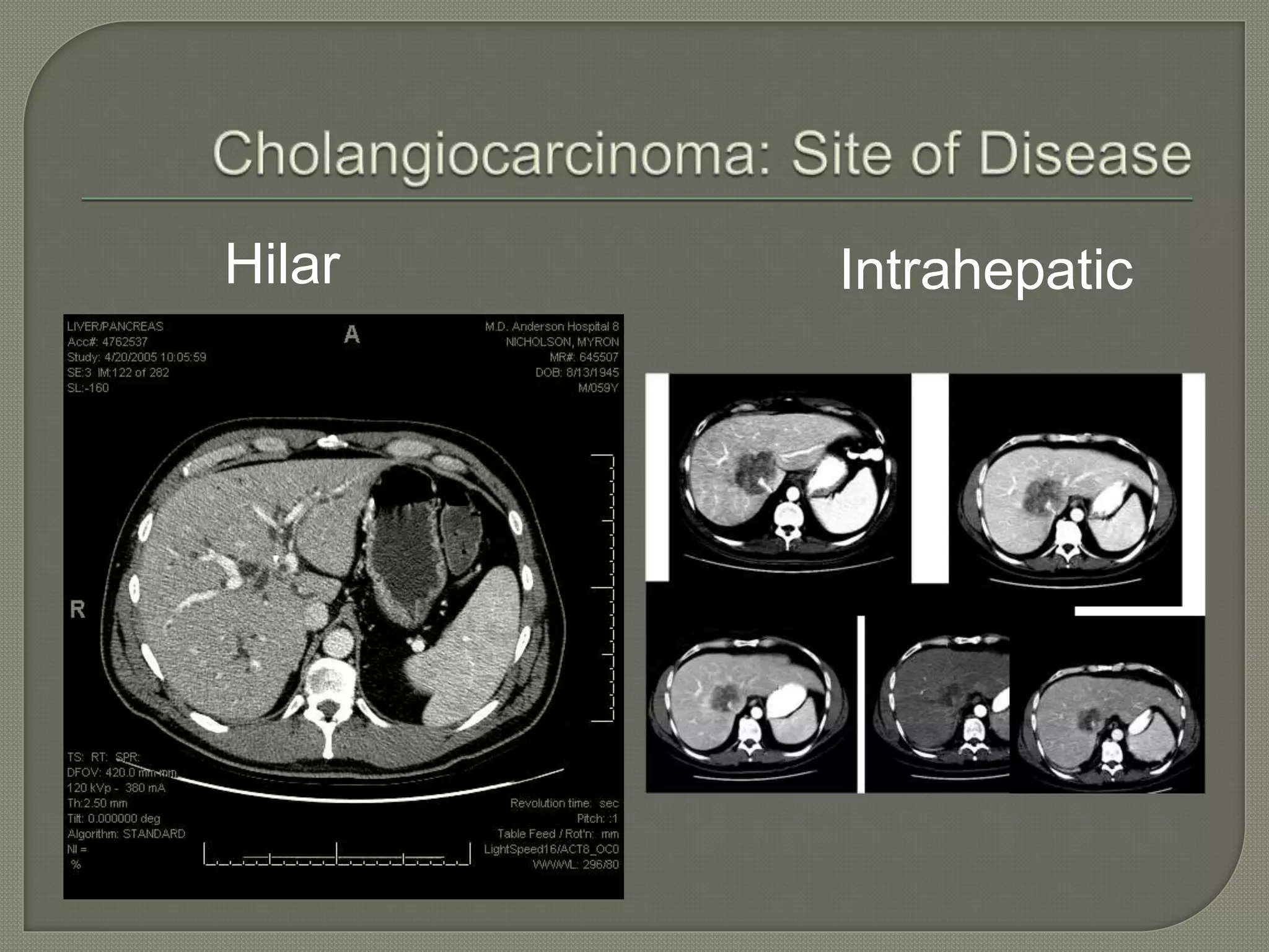 Hilar Intrahepatic 
 