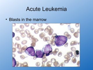 Acute Leukemia
• Blasts in the marrow
 