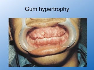 Gum hypertrophy
 