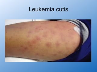 Leukemia cutis
 