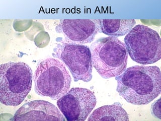 Auer rods in AML
 