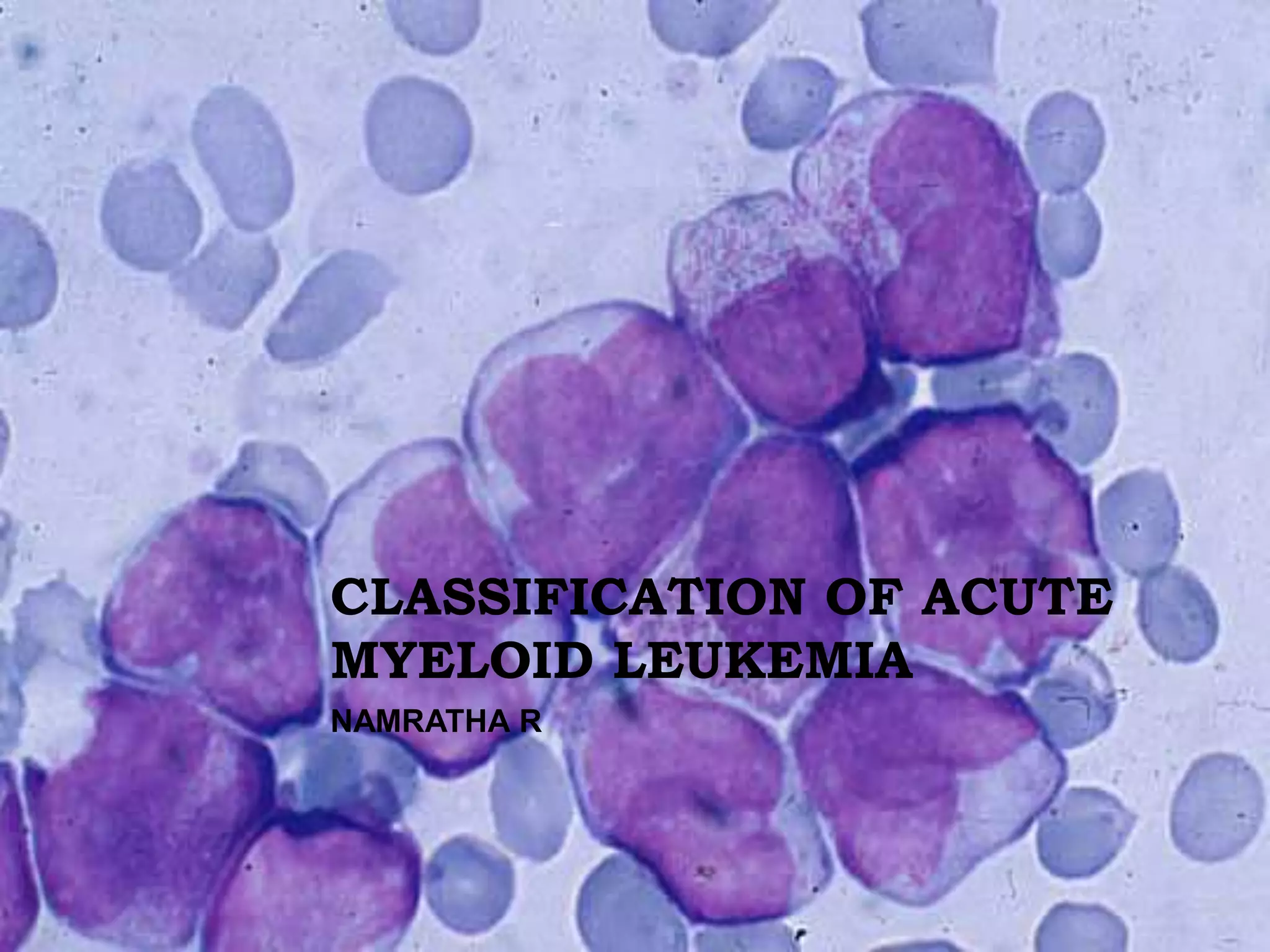 Acute myeloid leukemia | PPTX