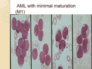 AML with minimal maturation
(M1)
 