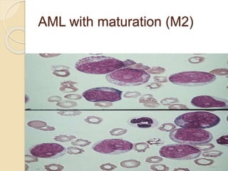 AML with maturation (M2)
 