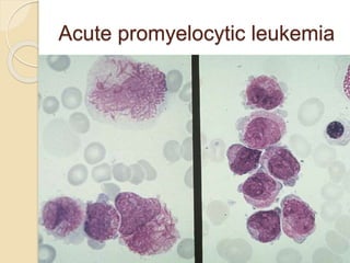 Acute promyelocytic leukemia
 